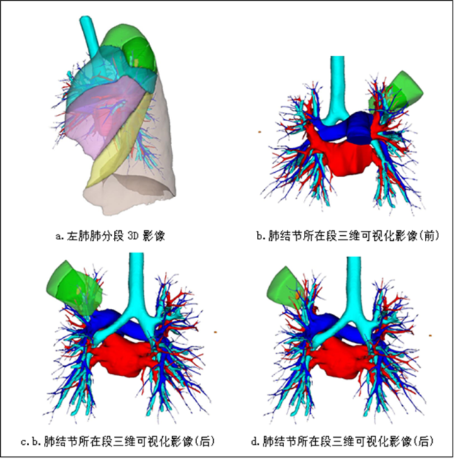 解剖性肺段切除手術較常規的肺葉手術更為精細,肺段手術需要辨識3-4級