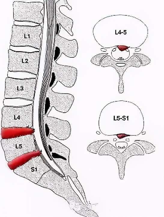 同样是腰椎间盘,为何腰4/5,腰5/骶1更"爱"突出?