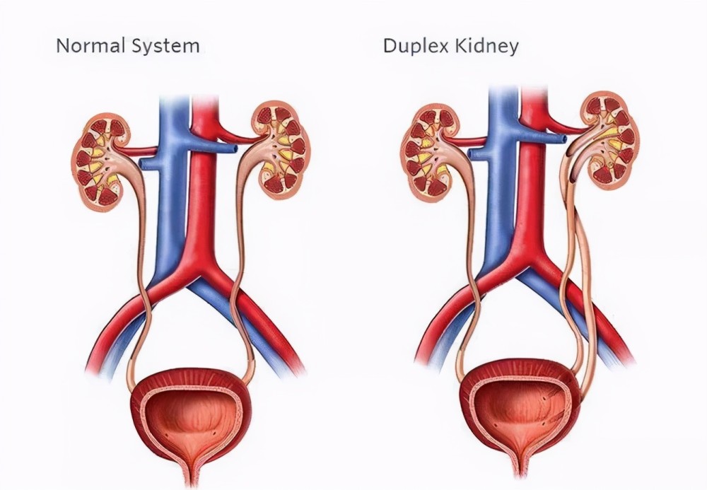 奇事:他竟然长了3个肾!_腾讯新闻