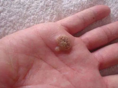 身上长瘊子,竟是感染了hpv?|hpv|千日疮|寻常疣|人乳头状瘤病毒