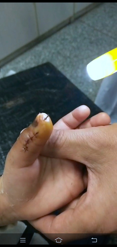 图为安徽歙县被摔打幼儿左手大拇指换药后的照片 受访者供图对于安徽