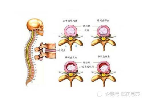 延安椎间盘突出邱悬壶图片