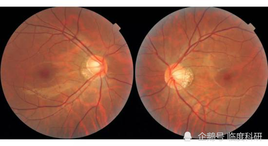临度影像组学分析|人工智能读眼底图像,判断视盘病变的auc达到0.96