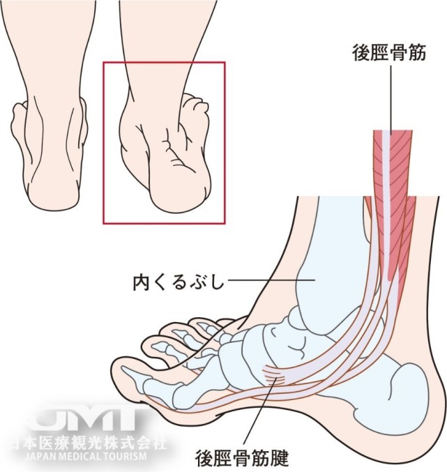 中老年女性常见的内脚踝疼痛 由于加龄和扭伤引起的胫后肌腱功能障碍 扁平足 胫后肌腱 脚踝 肌腱