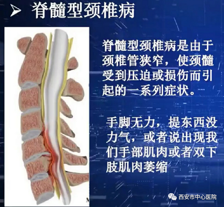 颈椎病您真的了解吗 腾讯新闻