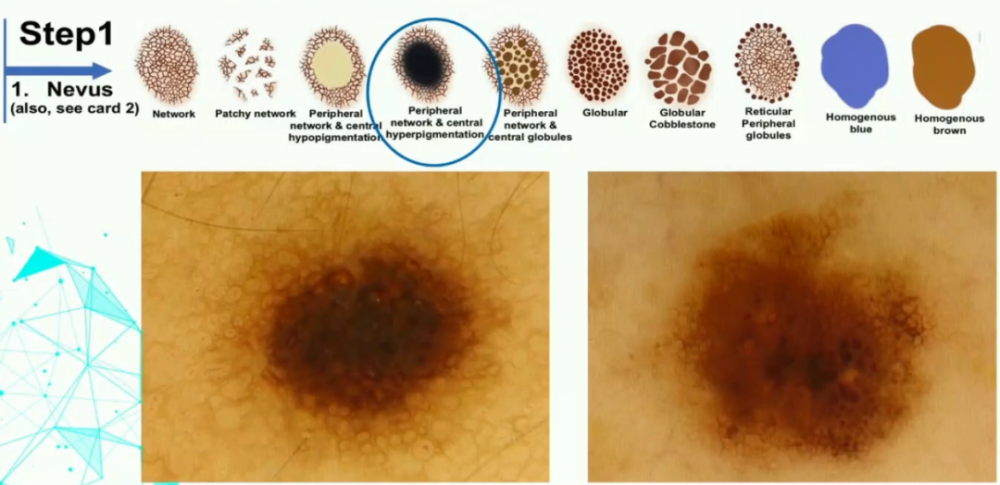 中央色素沉着外周网状结构