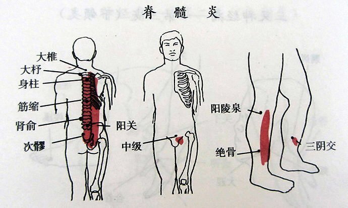 北京中医专家殷世荣脊髓炎都有哪些症状表现呢看看这里就知道了