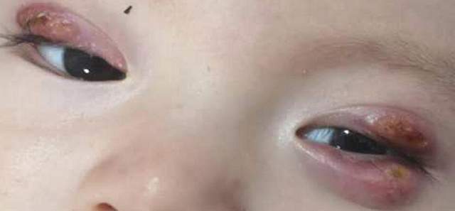 3岁娃长个针眼要做全麻手术医生拖久了可能破相