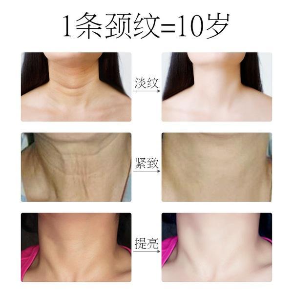 颈部皱纹该如何治疗玻尿酸脂肪胶与颈纹套盒该如何选择
