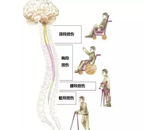 【神经康复】脊髓损伤的评定及康复治疗方案
