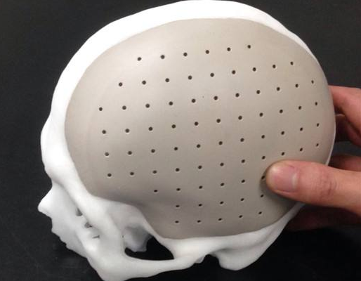 颅骨修复术后康复期