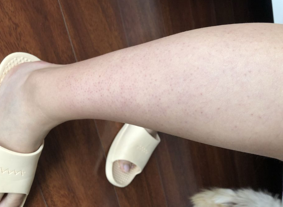 腿上有鸡皮肤怎么消除4种方法搞定鸡皮肤最有效