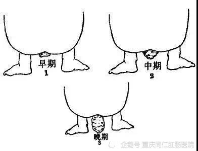 肛门脱出了小尾巴,不仅恐怖还痛