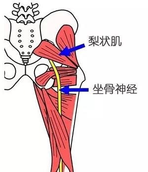 洛阳正骨医院田江波:小心是梨状肌综合征_腾讯新闻