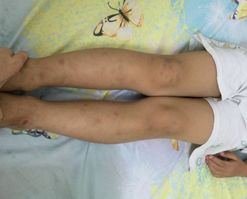 孩子缺钙时身体会出现4种信号多给孩子吃3物补钙质长个高