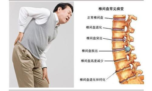 强直性脊柱炎位置图片