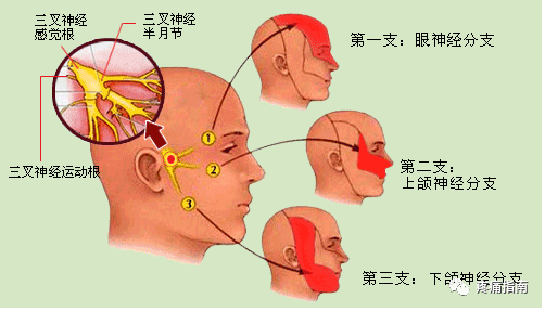 针刺兼镇静安神法治三叉神经痛