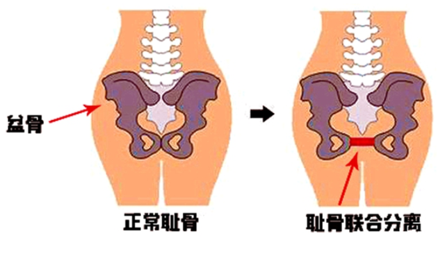 孕晚期的 耻骨痛 有多难熬 走一步疼一下 90 的产妇都中招 腾讯新闻