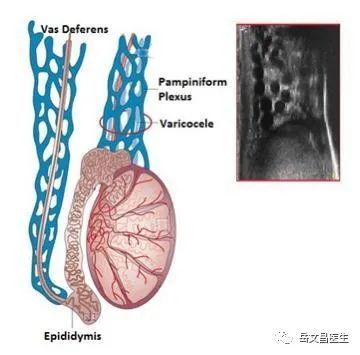 精索静脉曲张实图图片