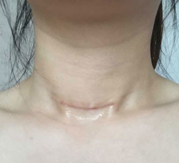 甲状腺切除手术,术后半年结节再次复发,究竟发生了什么?