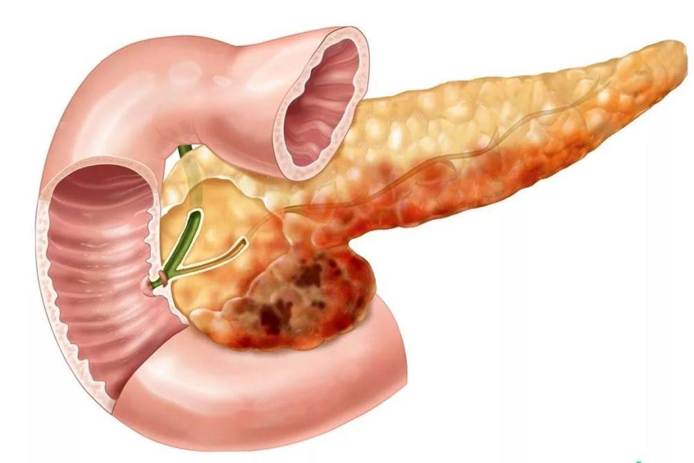 高危人群是胰腺癌预防的重点,出现这些症状要小心胰腺癌!