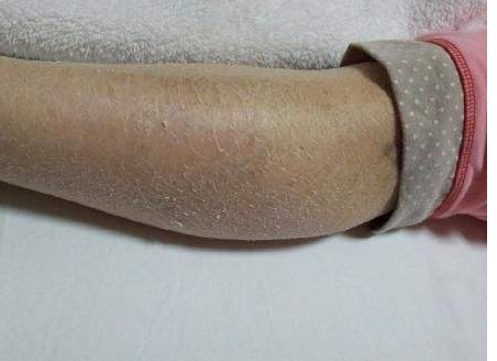今天比昨天又干沙漠干皮秋冬该如何自救