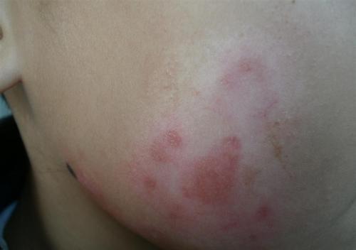 抠脚一时爽,一直抠脚一直爽,医生直言:你脸上为什么会有脚气?