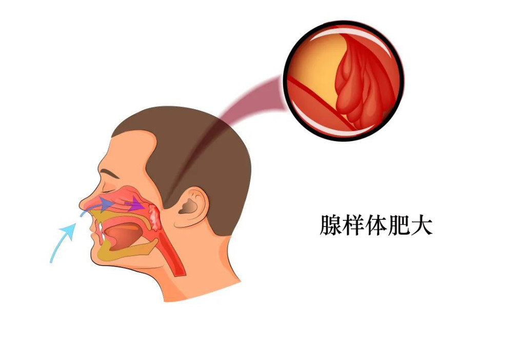 【中民耳鼻喉科普】腺樣體肥大怎麼辦?