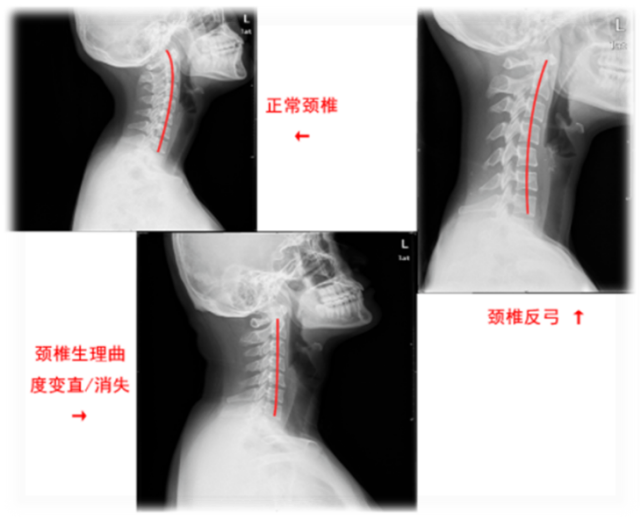 颈椎病的3 种检查 两种治疗方法 医生想告诉你的小知识 钩椎关节 颈椎病 手术 颈椎 颈部