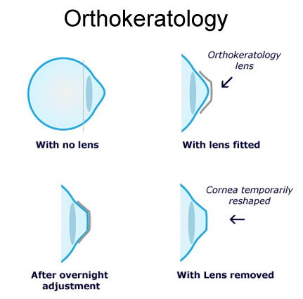 ok镜|矫正近视，OK镜到底OK不OK？