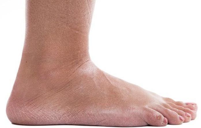 为什么有些人脚后跟经常开裂可能与这几个原因有关尽量别忽视