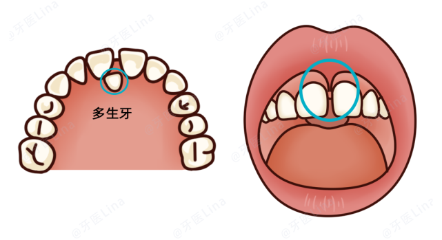 (左:多生牙;右:唇繫帶附著過低 )寶爸寶媽們重視孩子的牙齒是非常好的