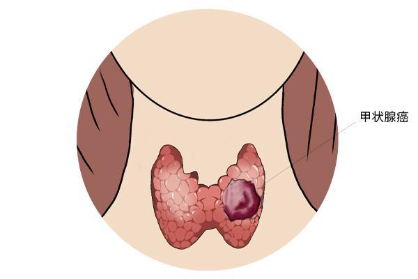醫生查出甲狀腺結節有些食物該從餐譜上劃掉別餵養結節