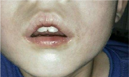 此外,如果长期张口呼吸,会影响面骨发育,上颌骨狭长,硬腭高拱变窄.