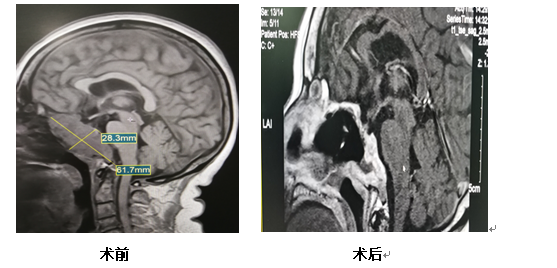 可怕 大妈流 鼻涕 长达一个月 医生却说 你流的是脑脊液 腾讯新闻