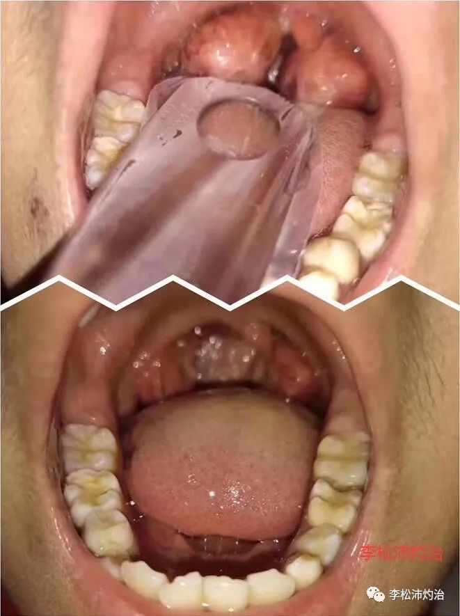 扁桃体肥大怎么办最简单的方法附送扁桃体肥大的原因