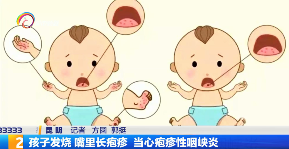 孩子發燒 嘴裡長皰疹 當心皰疹性咽峽炎