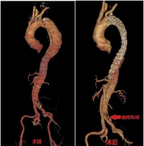 山大二院应用开窗,分支支架技术成功治愈复杂主动脉夹层_腾讯新闻