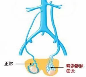 精索靜脈曲張是什麼病?