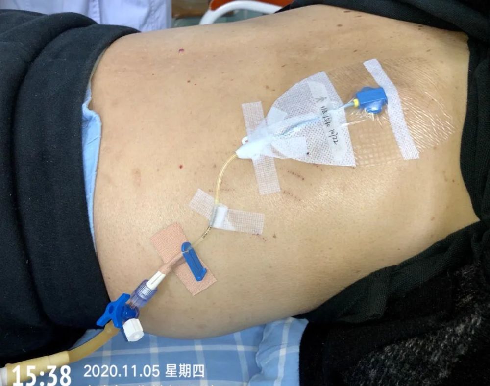 严格掌握胸腔闭式引流负压吸引的