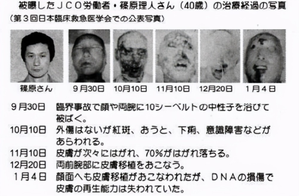 核辐射可以恐怖到什么程度?全身DNA断裂，缓慢体验死亡