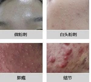 青春痘的困扰快走开奉贤区皮肤病防治所开设痤疮专病门诊