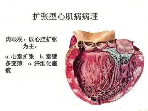 导致一代球王马拉多纳猝死的"扩张性心肌病",是怎么回事儿?