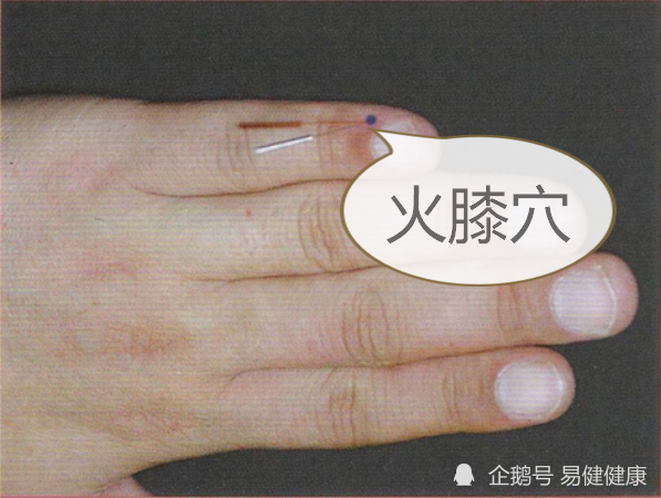 中医健康养生之人体手部穴位火膝穴