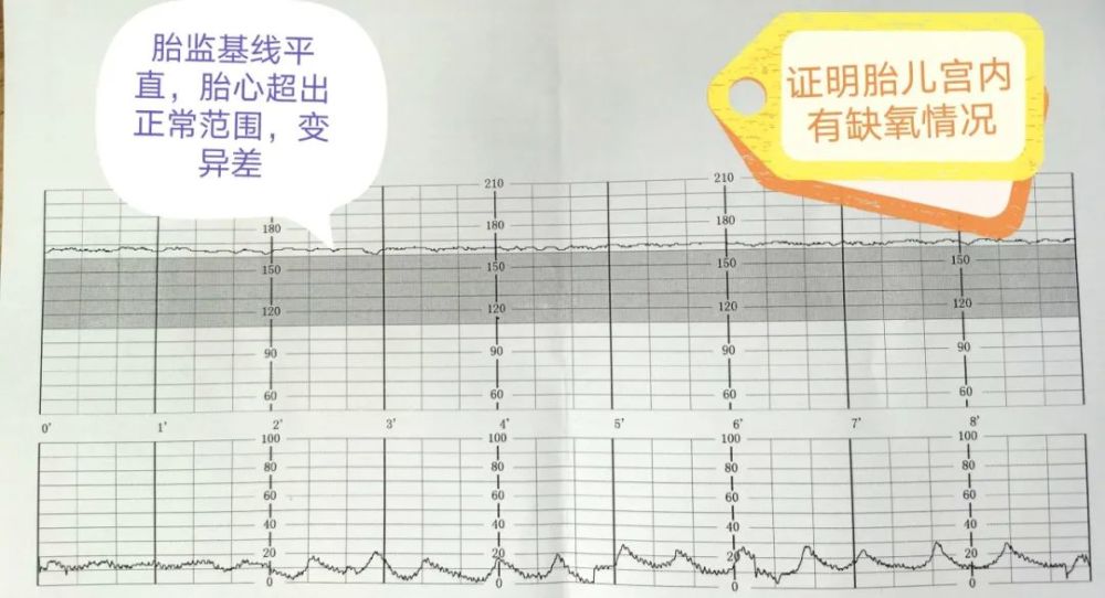 敏锐医护及时发现藏起来的胎盘早剥紧急绿色通道护航大小平安