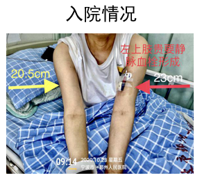 picc并发静脉血栓抗凝治疗要多久拔管时血栓会脱落吗