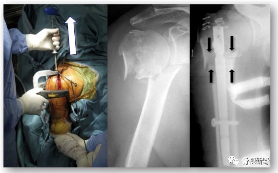 【骨科小技巧】肱骨近端骨折的直型髓內釘固定技術!