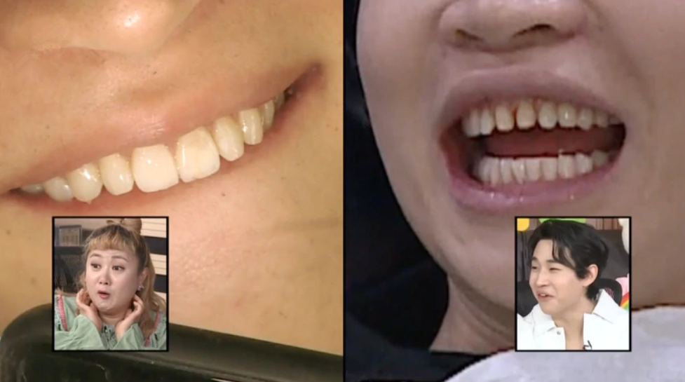 31岁人气男星毫无偶像包袱,上节目首度展示蛀牙,坦言