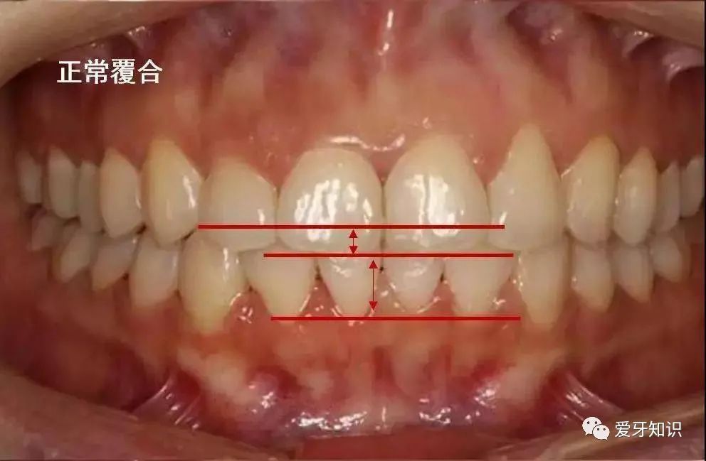深覆盖和深覆合怎么分这一篇看完就都明白了