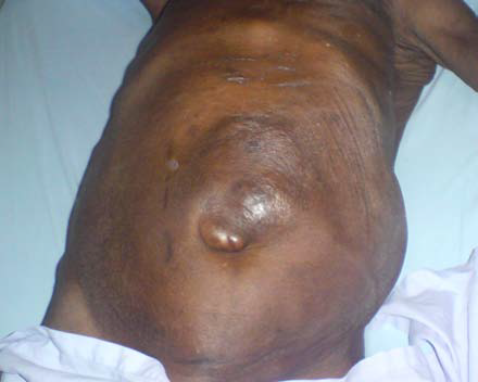 腹腔恶性肿瘤的"信号":这种脐周结节你见过吗?